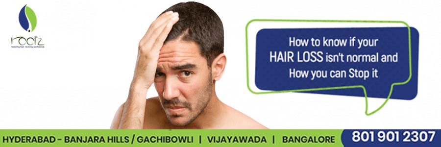 hair-loss-how-much-is-normal-and-what-you-can-do-about-it