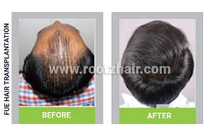 FUE Hair Transplant before and after image