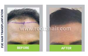 fue hair transplant before and after pictures
