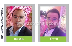 fue hair transplant before and after pictures