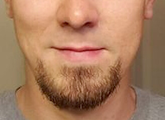 Beard Hair Transplant Surgery