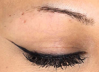 Eyebrow transplant give perfect shape 