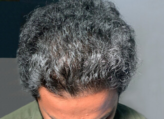  Hair transplant correction1 before and after